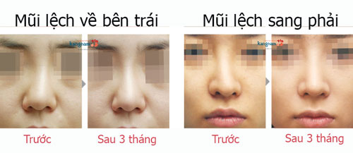 mũi lệch