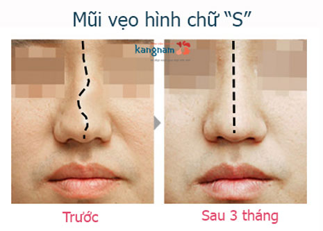 mũi lệch về bên trái