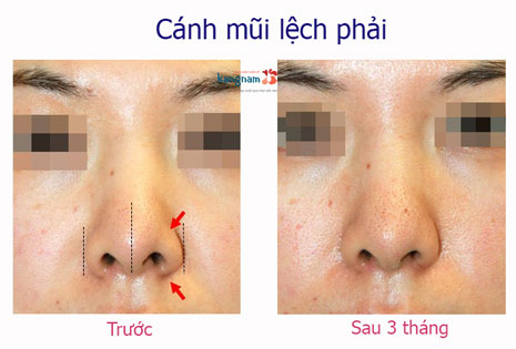 đầu mũi bị lệch