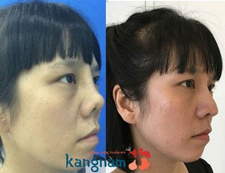 Các trường hợp mũi ngắn do hỏng thẩm mỹ thì Kangnam đều tiếp nhận và chỉnh hình đẹp nâng mũi vĩnh viễn