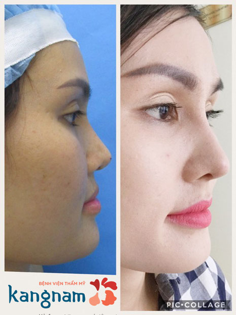 chỉnh hình mũi ngắn 