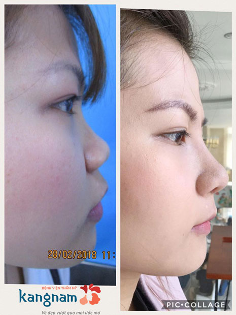 nâng mũi tại Kangnam nâng mũi tại Kangnam