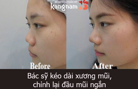 Đối với trường hợp đầu mũi ngắn bác sỹ buộc phải kéo dài xương và bọc đầu mũi bằng sụn tai nâng mũi cấu trúc 4D