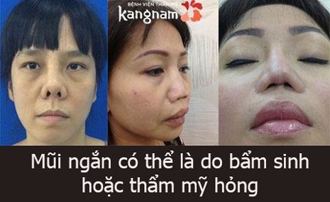 Chỉ có 2 nguyên nhân chính dẫn đến chiếc mũi bị ngắn mũi ngắn tướng số