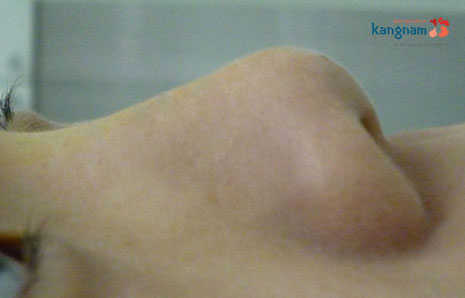 Đầu mũi ngắn khiến lỗ mũi "lộ thiên" mũi ngắn