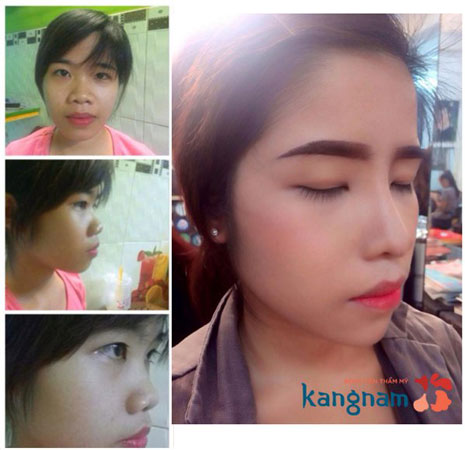 Khách hàng K.L (Hà Nội) đã hỉnh hình mũi ngắn bằng công nghệ nâng mũi cấu trúc 4D tại Knagnam sửa mũi ngắn