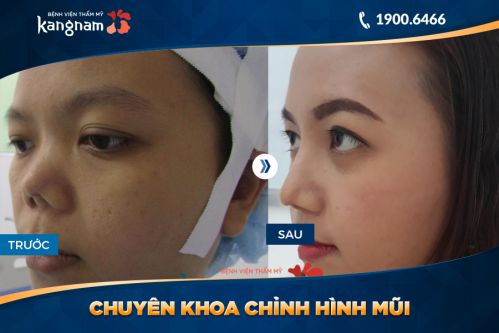 kết quả chỉnh sửa mũi hếch
