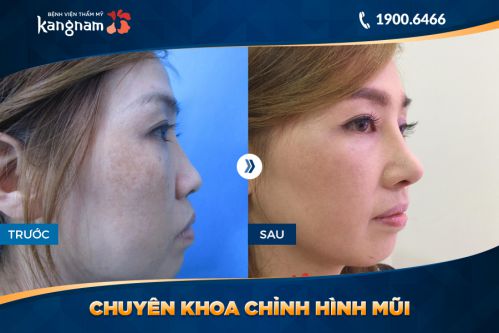kết quả sửa mũi hếch