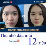 Chi phí thu gọn đầu mũi giá bao nhiêu? Đ/C Thu nhỏ đầu mũi ở đâu đẹp?