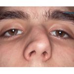 Đầu mũi bị lệch phải làm sao? Chỉnh sửa mũi lệch giá bao nhiêu tiền?