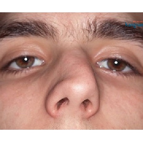 Đầu mũi bị lệch phải làm sao? Chỉnh sửa mũi lệch giá bao nhiêu tiền?