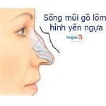 Mũi bị gồ là như thế nào? Nam, nữ có sống mũi gồ tướng số ra sao??