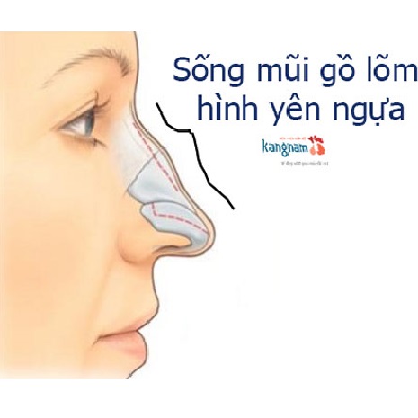 Mũi bị gồ là như thế nào? Nam, nữ có sống mũi gồ tướng số ra sao??