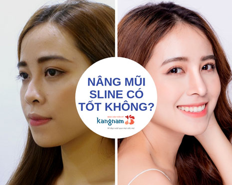 nâng mũi s line có tốt không