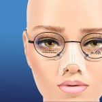 Nâng mũi có đeo kính được không? Nếu kiêng thì khoảng bao lâu?