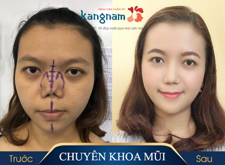 Sửa mũi tại Kangnam