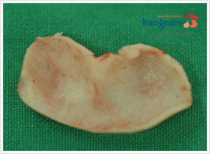 Sụn tai lấy ở đâu