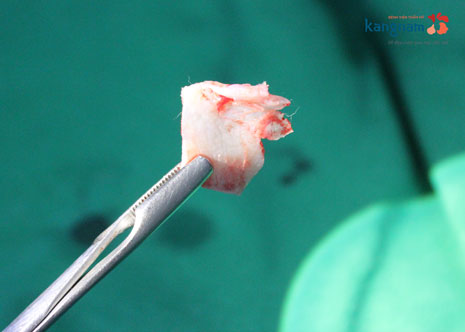 Sụn vách ngăn lấy ở đâu