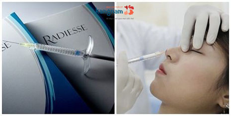 nâng mũi bằng tiêm Filler