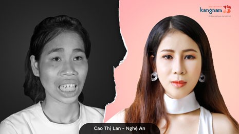 mũi dọc dừa là mũi như thế nào