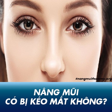 Nâng mũi có bị kéo mắt không? Nếu nâng mũi bị kéo mắt phải làm sao?