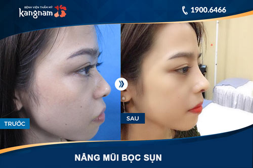 hình ảnh nâng mũi bọc sụn ở kangnam