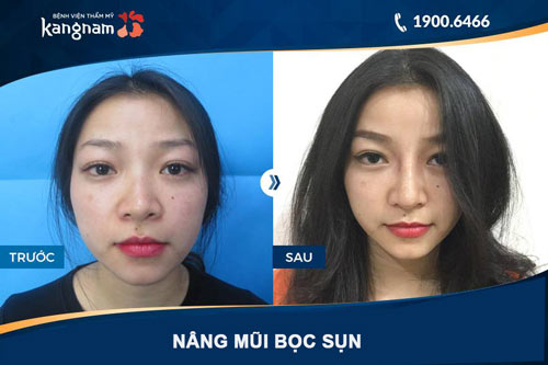 hình ảnh nâng mũi bọc sụn tại kangnam