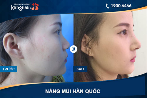 hình ảnh nâng mũi bọc sụn