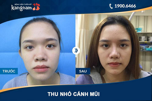 hình ảnh thu gọn cánh mũi