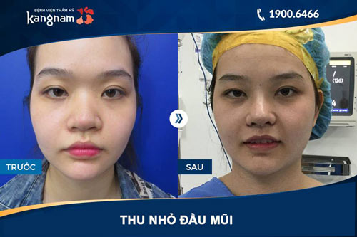 hình ảnh thu nhỏ đầu mũi tại kangnam