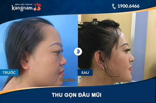 hình ảnh thu nhỏ đầu mũi