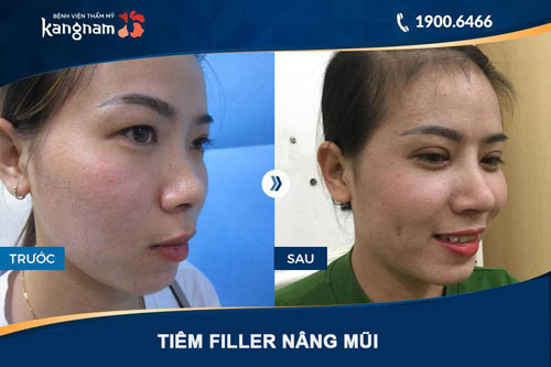 hình ảnh tiêm filler mũi ở kangnam