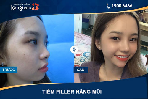 hình ảnh tiêm filler nâng mũi tại kangnam