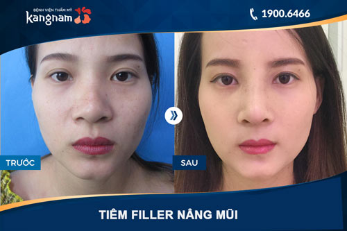 hình ảnh tiêm filler mũi