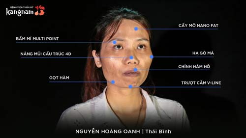 Nguyễn Hoàng Oanh hành trình lột xác phẫu thuật thẩm mỹ