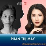 Phan Thị May lột xác xinh đẹp cùng công nghệ nâng mũi 4D tại Kangnam!!