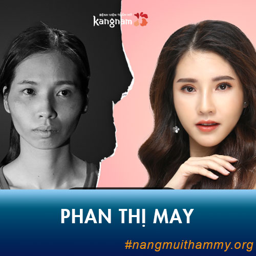 Phan Thị May lột xác xinh đẹp cùng công nghệ nâng mũi 4D tại Kangnam!!
