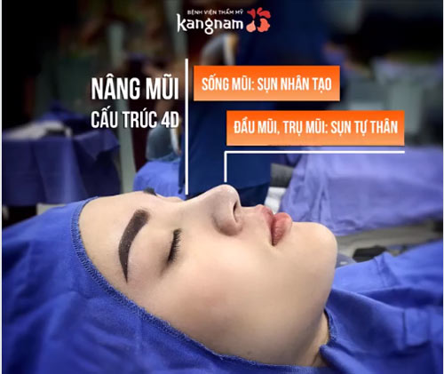 phẫu thuật nâng mũi
