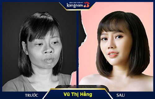 sửa mũi kangnam