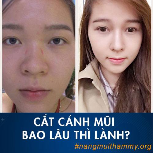 Cắt cánh mũi bao lâu thì lành, hết sưng và đẹp tự nhiên? Liệu có để lại sẹo không?