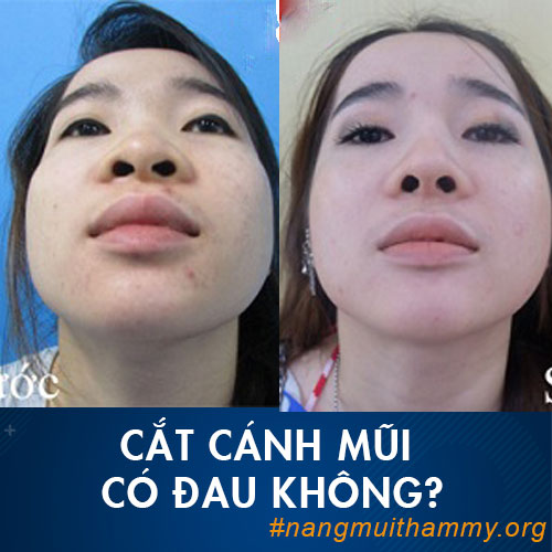 (Thu gọn cánh mũi) Cắt cánh mũi có đau không? Có nguy hiểm không??