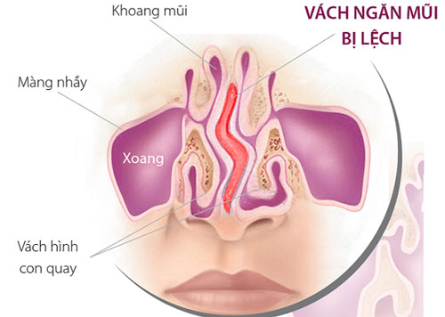 Bệnh vviêm mũi dị ứng mãn tính