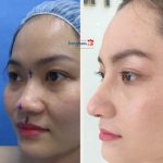 Nâng mũi L line là gì? Nâng mũi L line bao nhiêu tiền? Có vĩnh viễn không?