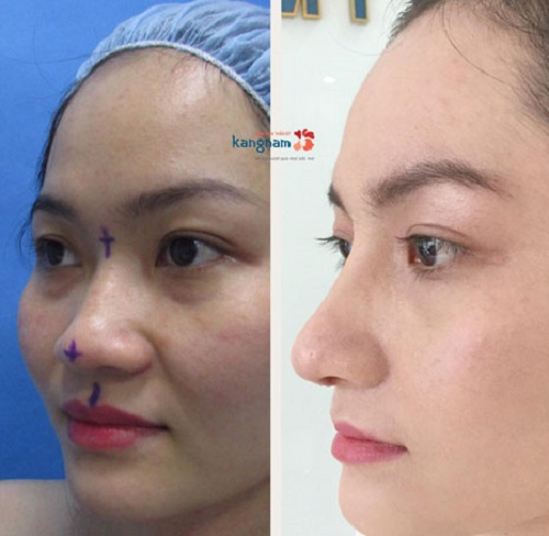 Nâng mũi L line là gì? Nâng mũi L line bao nhiêu tiền? Có vĩnh viễn không?