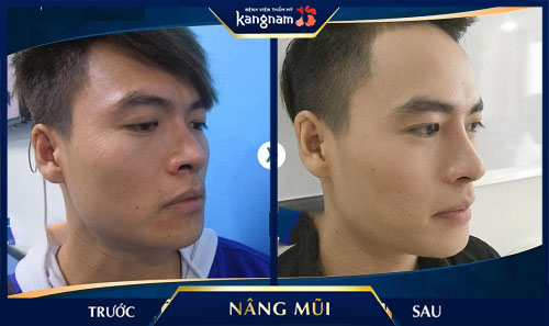 nâng mũi s line 3d kangnam