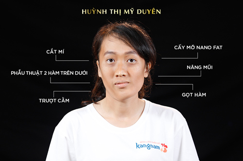 Hành trình lột xác có 1 không 2 của cô gái “mặt vặn xoắn” hiếm có