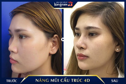 nâng mũi cấu trúc 4D bao lâu gom lại