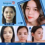 Nâng mũi cấu trúc bao lâu thì lành? Mẹo nhỏ giảm thời gian lành thương