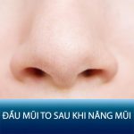Đầu mũi to sau khi nâng mũi | Nguyên nhân và cách khắc phục hiệu quả
