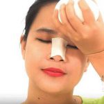 Những Hiện tượng & Biến chứng sau khi nâng mũi Thường Gặp